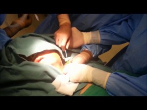 Management of a pulled out catheter