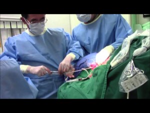 Insertion of retro catheter for HD