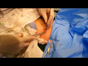 Reinsertion of Tenckhoff's catheter