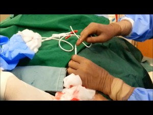 The insertion and application of Hickman's catheter